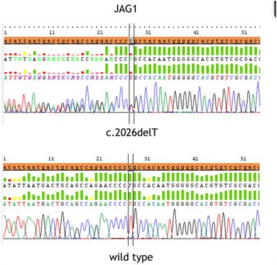 Alagille Syndrome: A Novel Mutation in JAG1 Gene